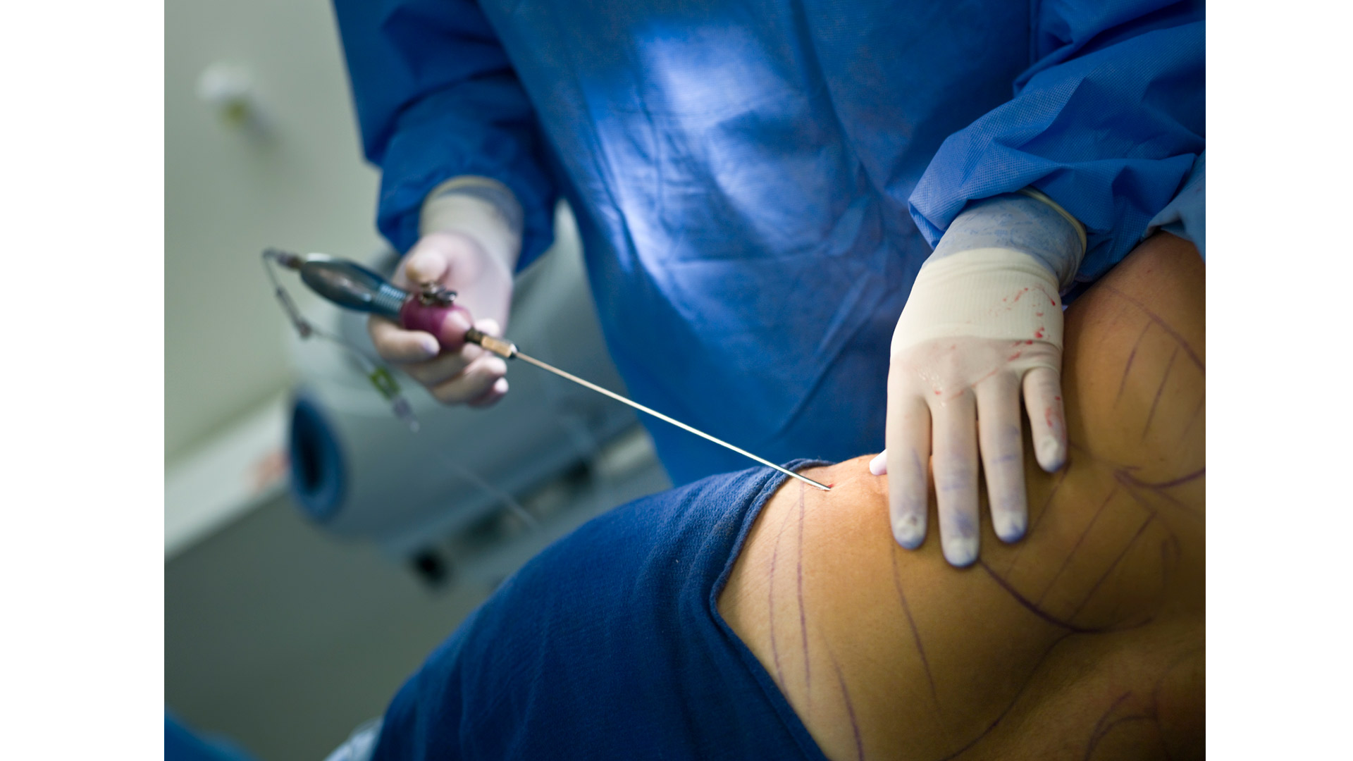 LIPO
