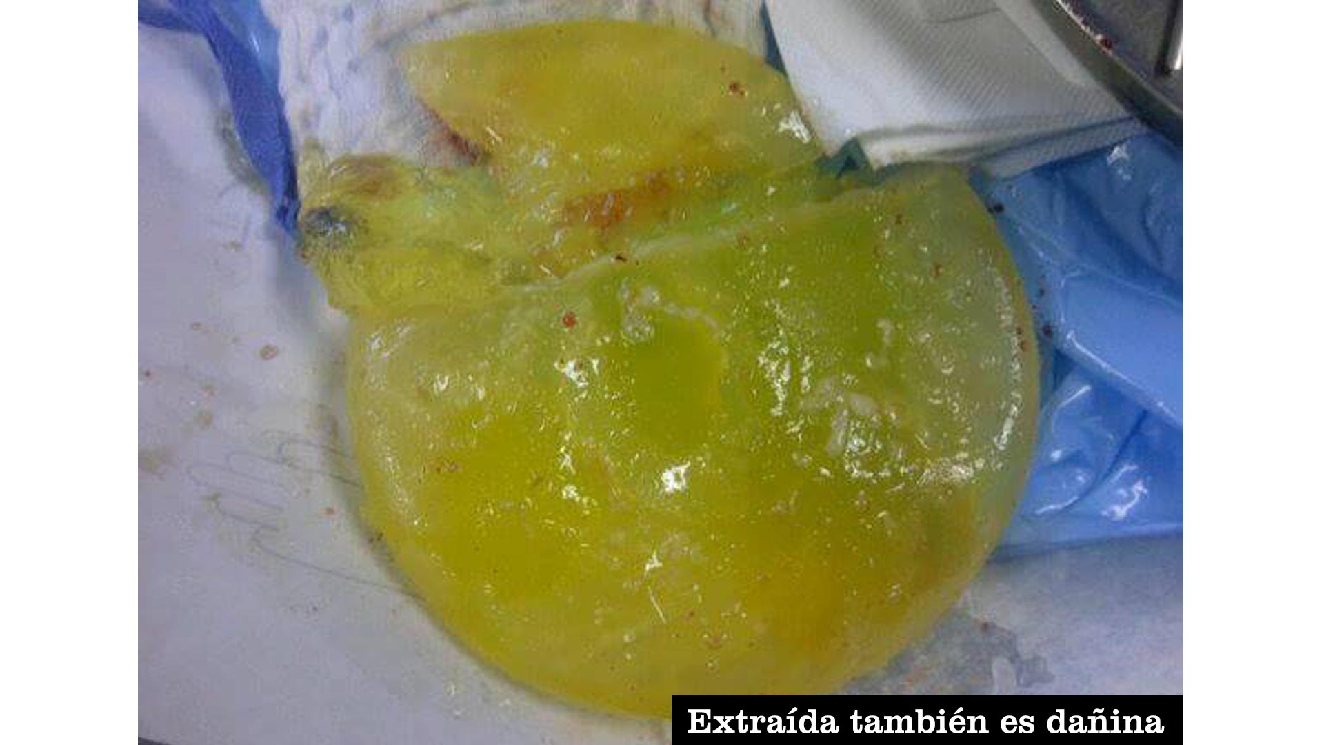 Implantes6-1