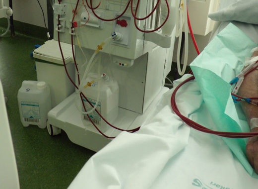 hemodiálisis