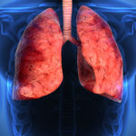 neumonía, pulmones