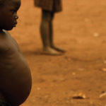 Kwashiorkor