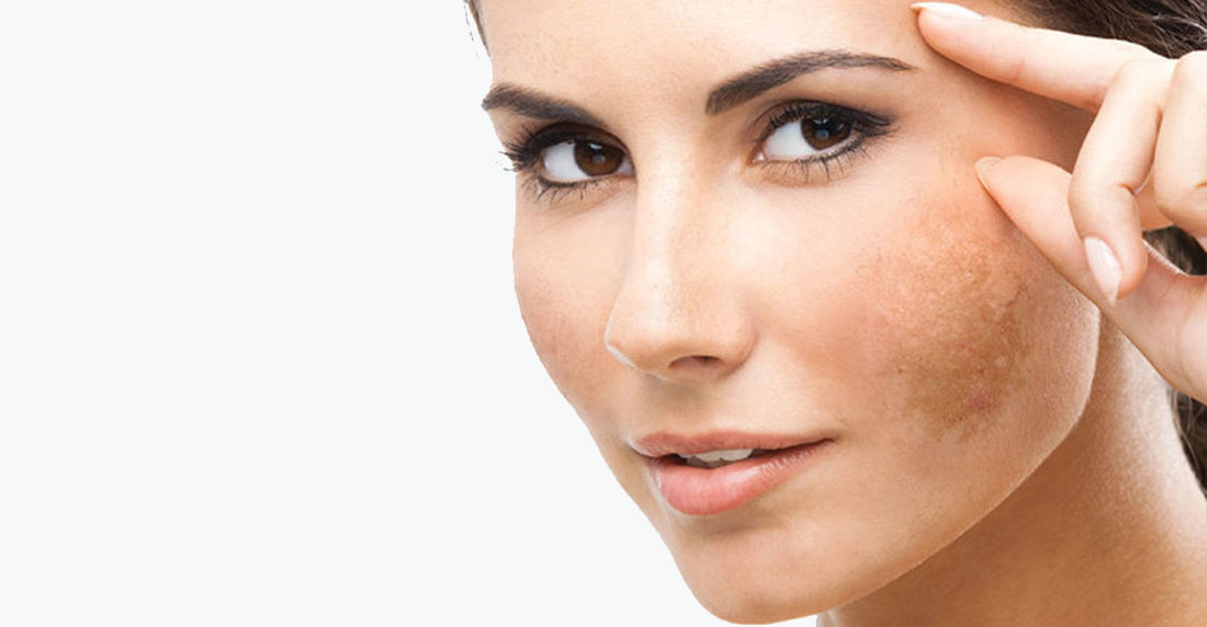 melasma
