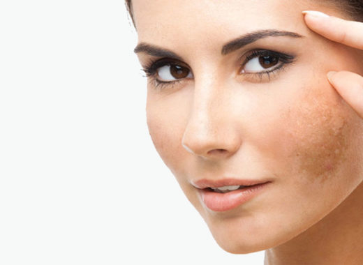 melasma