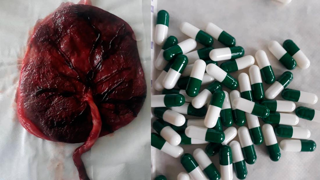 Foto: A la izquierda, la placenta en su forma natural y a la derecha, la placenta hecha en cápsulas. Cortesía: María Corina Villegas