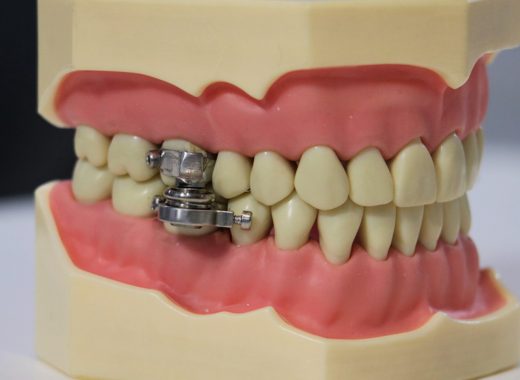 DentalSlim Diet Control