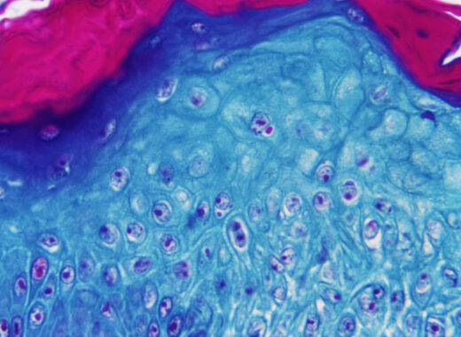 Alemania viruela del mono