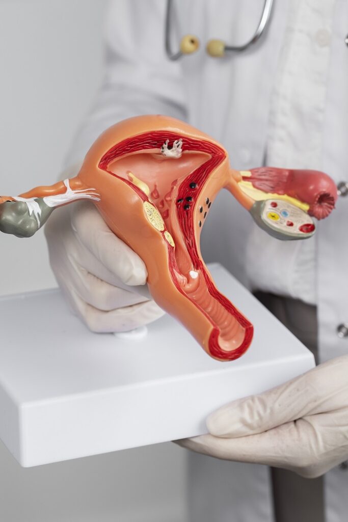  cáncer de cuello uterino