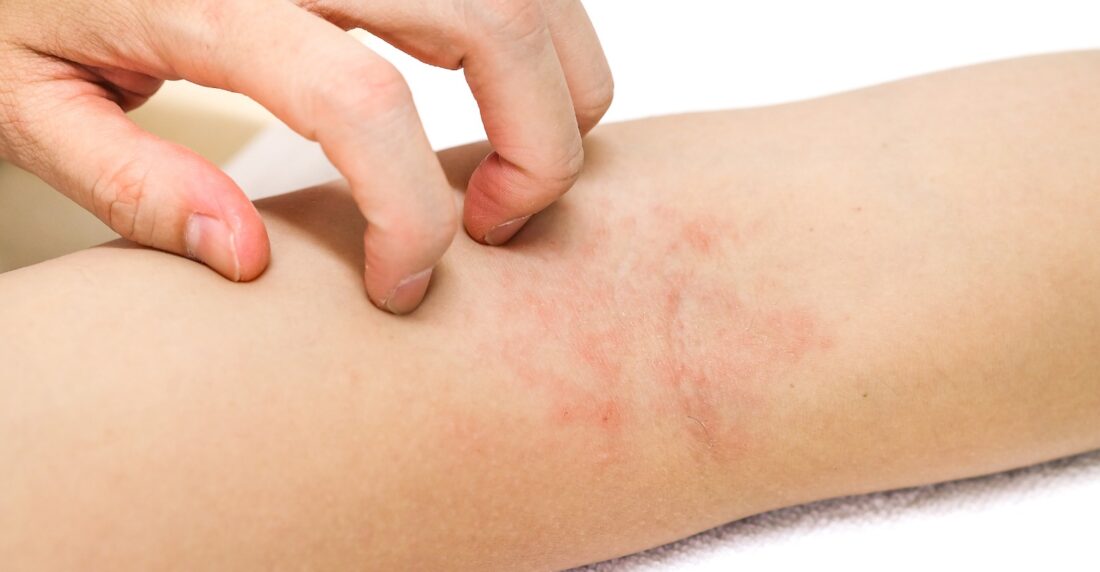 el calor aumenta la dermatitis atópica