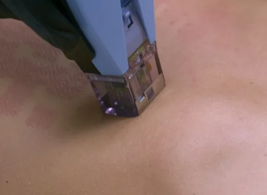 Nuevo tratamiento estético combate la flacidez en distintas profundidades de la piel