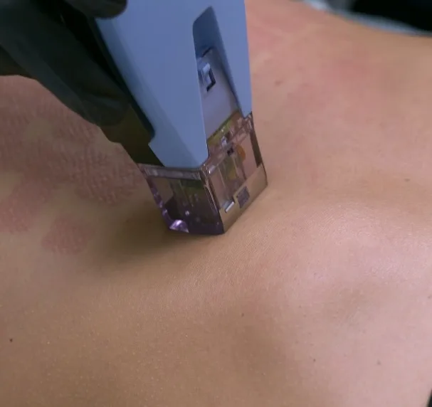 Nuevo tratamiento estético combate la flacidez en distintas profundidades de la piel